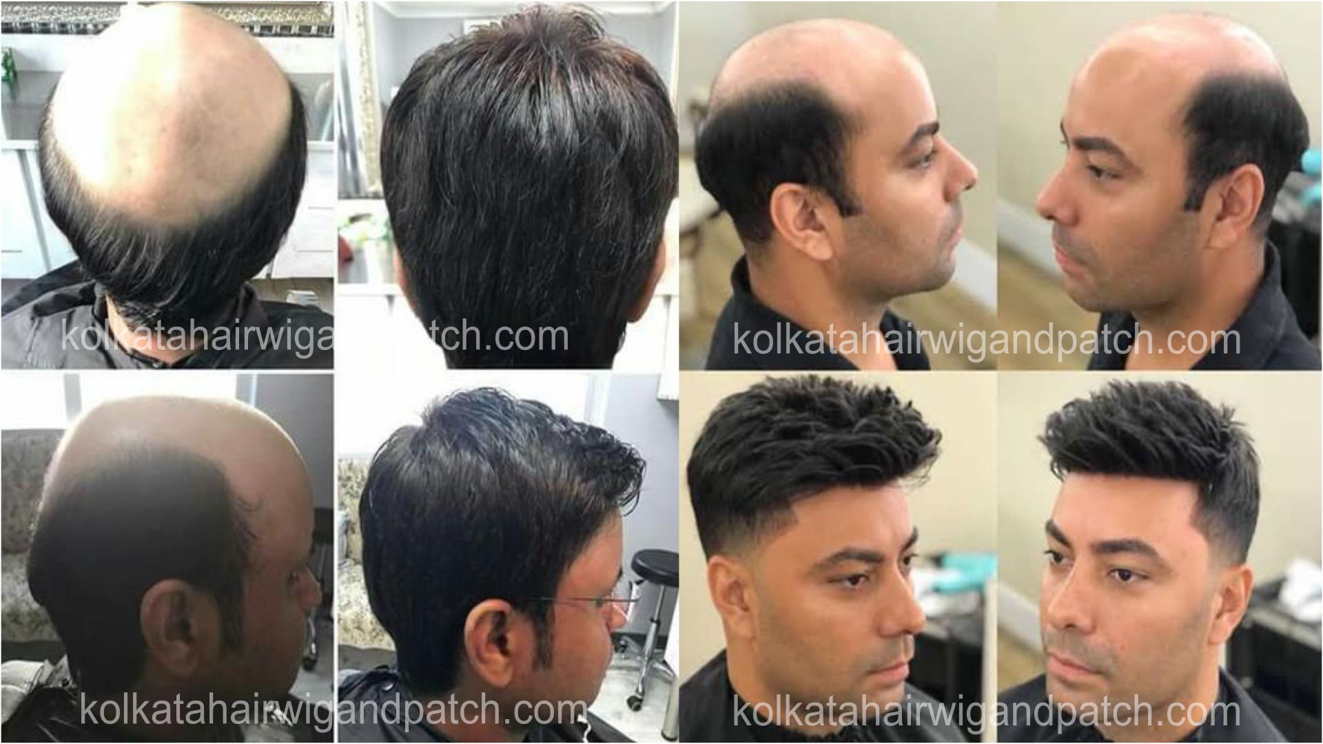 Men-Hair-Patch